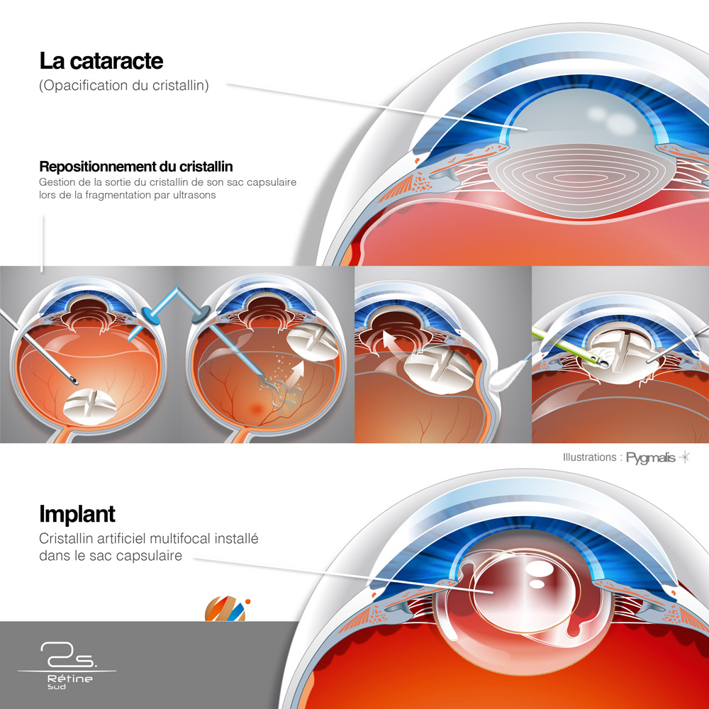 Illustrations médicales et chirurgicales - Rétine Sud - Clinique d'ophtalmologie à Montpellier